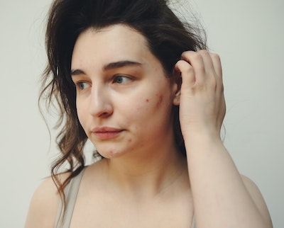 At What Stage Of Pregnancy Do You Get Acne?