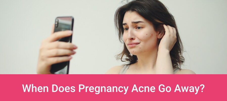 When Does Pregnancy Acne Go Away?