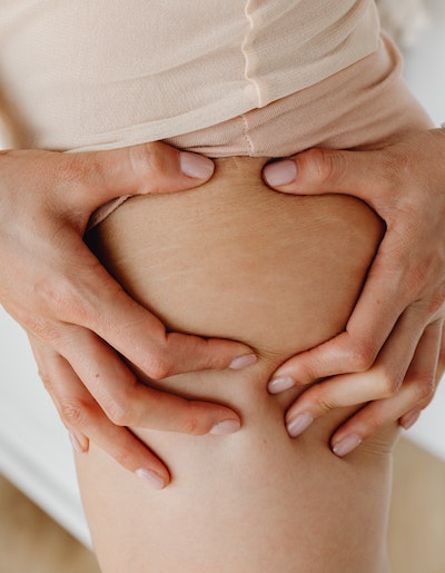 Stretch marks postpartum body changes - stretch marks