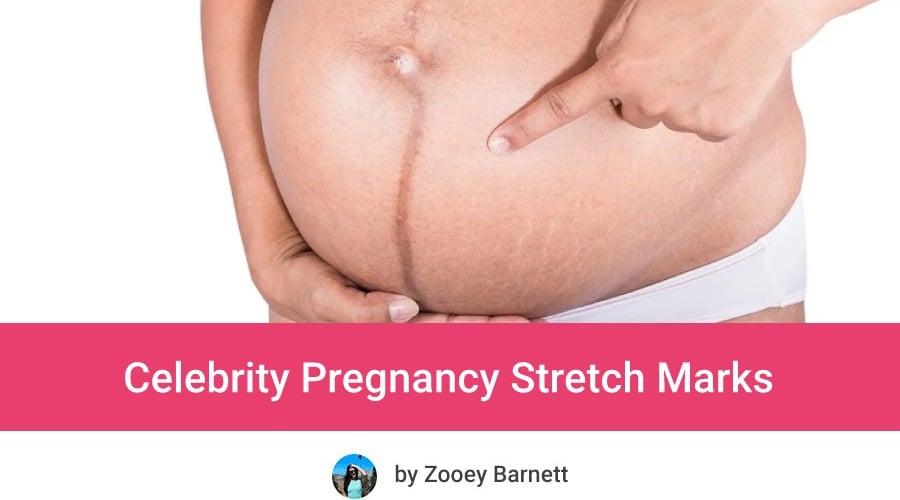 Celebrity Pregnancy Stretch Marks