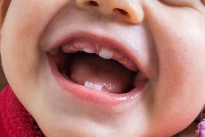 Does It Matter If Baby Teeth Come In The Wrong Order